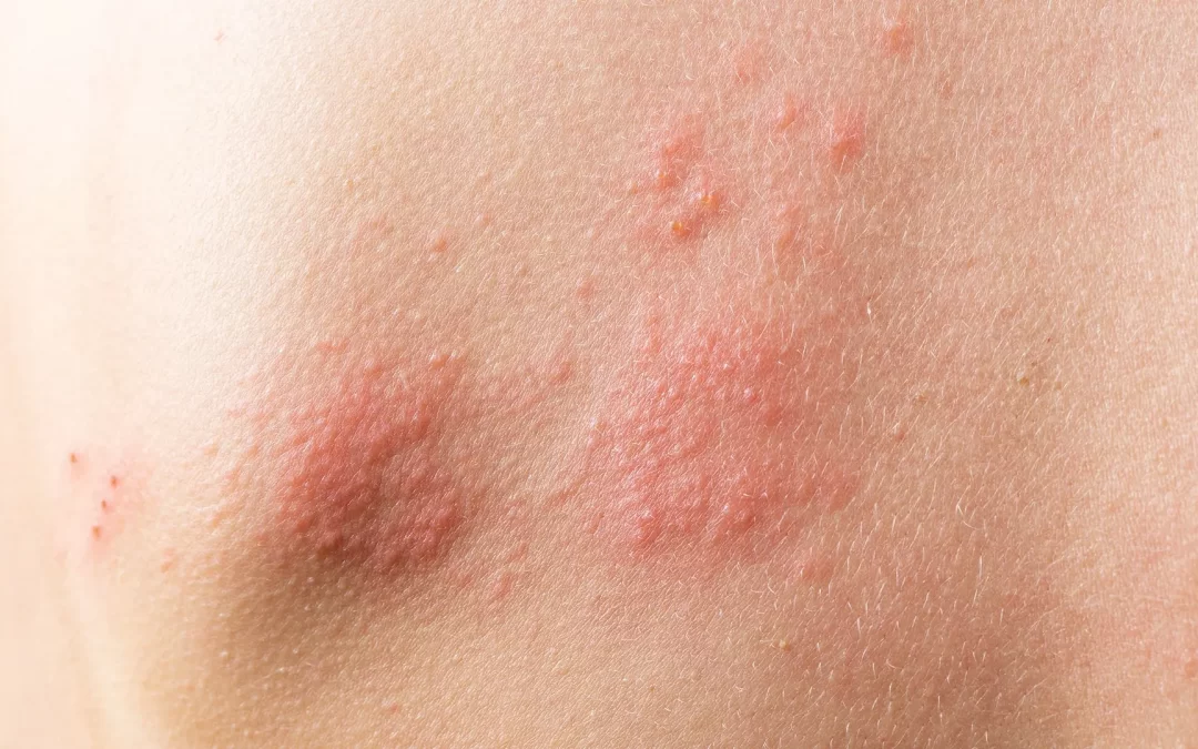 Herpes Zóster é influenciada pelo estresse e baixa imunidade